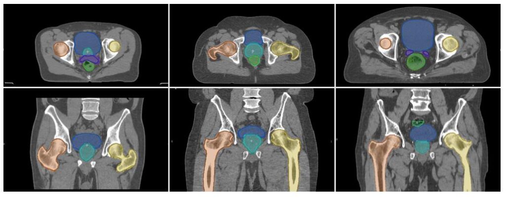 Radiotherapy segmentation examples
