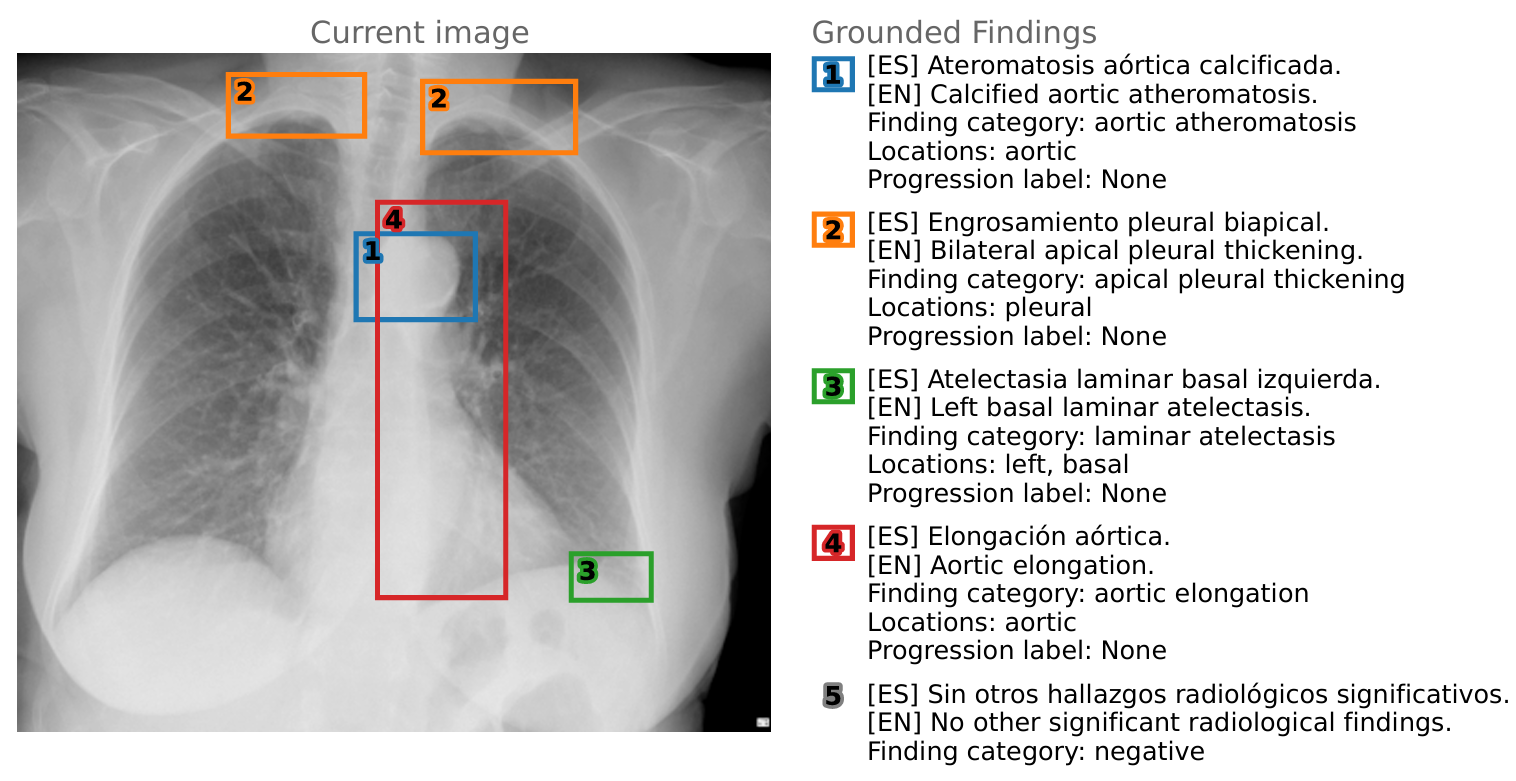 Figure 1: A chest X-ray overlaid with numbered bounding boxes, next to a matching list of structured radiological findings in Spanish and English. 