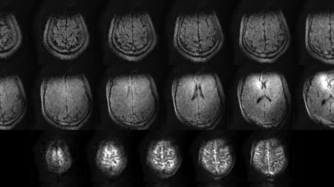 Tyger - portable MRI story: comparison of MRI scans
